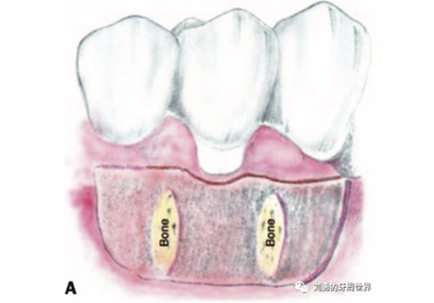 FGG游离牙龈移植在历史上的各种改良以及发展前景