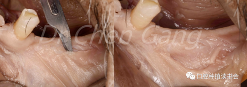 高清图解｜游离牙龈（FGG）的获取与移植技术