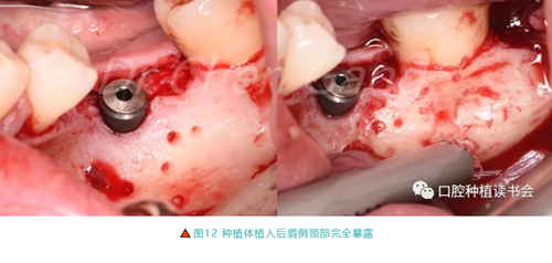 高清图解｜游离牙龈（FGG）的获取与移植技术