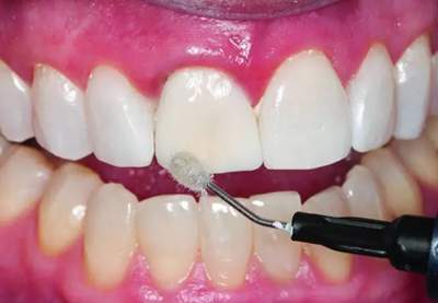 氟斑牙的克星--美国皓齿微创治疗法