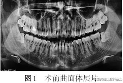 病例报告 | 下颌第三磨牙拔除术后并发双侧广泛性皮下气肿及纵隔气肿1例报告