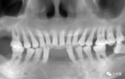 【病例分享】应用全程数字化对牙周炎患者实现全口即刻种植即刻修复