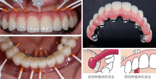 【病例分享】应用全程数字化对牙周炎患者实现全口即刻种植即刻修复