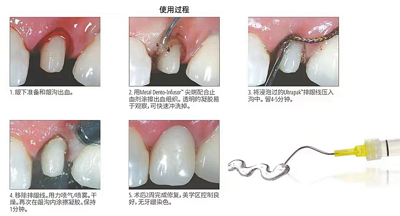 皓齿止血排龈凝胶