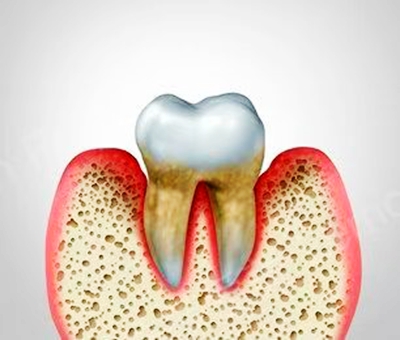 牙周病总是来势汹汹？有办法预防吗？
