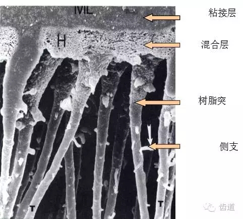 总结 牙本质表层酸蚀处理,以去除玷污层及其管塞,并使牙本质脱矿,但